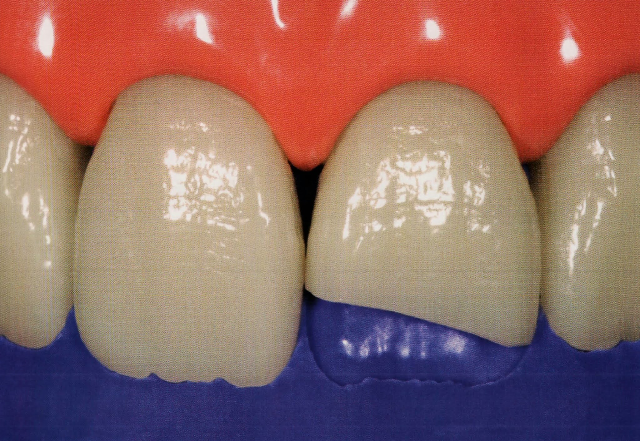 Class IV composite " silicone guide technique " Dental Esthetics