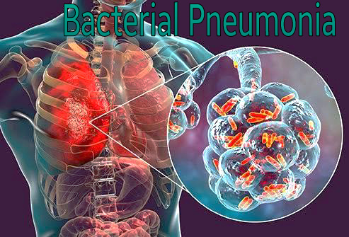Pneumonia diagram, bacterial pneumonia