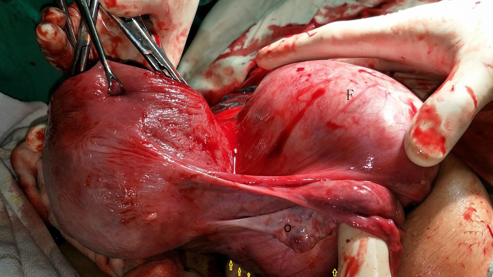 Classical Cesarean Section For Large Central Cervical Fibroid 