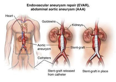 Source: https://www.communityhealthmagazine.com/community/new_york/thompson_health/advanced-aneurysm-fix-introduces-shorter-road-to-recovery/article_437b8ce6-e7cb-11e6-8bdf-17c1a7cd2d25.html