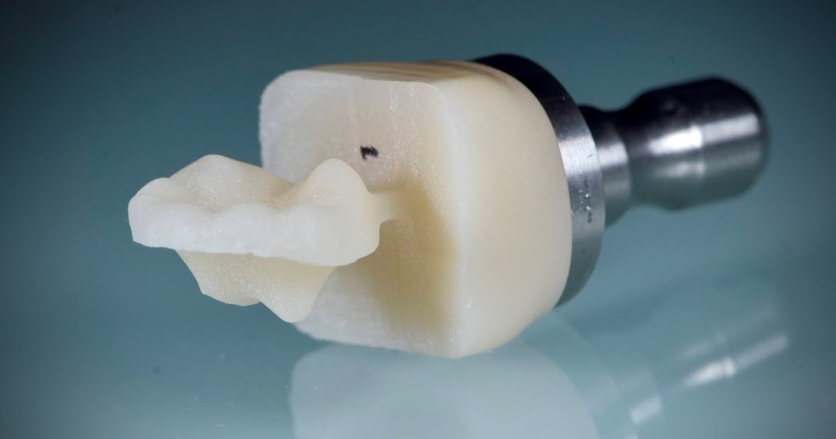 Endocrown .. Full documentation of a clinical case Dental Esthetics