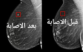 الكشف على سرطان الثدي