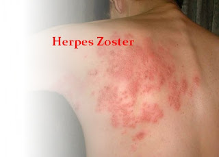 Pengobatan Alternatif Herpes Zoster