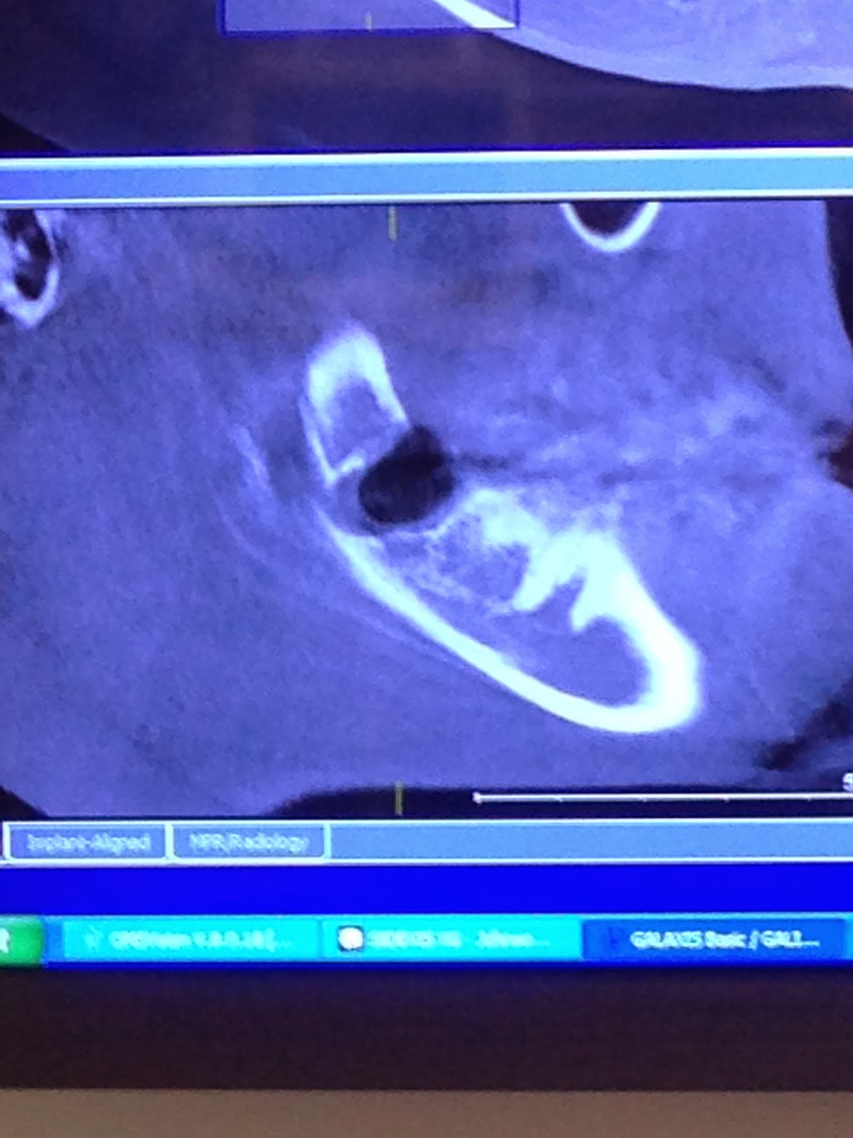 Wisdom Tooth Fiasco My Bout With Osteomyelitis