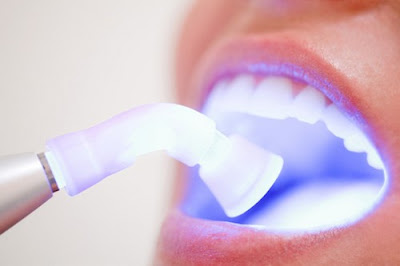 Tẩy trắng răng có tốt không?