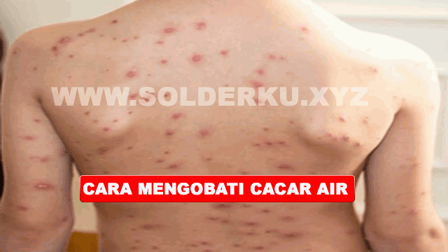 6 CARA MENGOBATI CACAR AIR