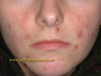 Acne No More System Ebook