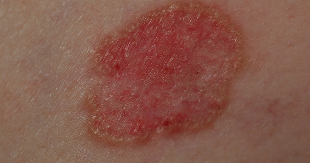 Skin Cancer Rash On Back