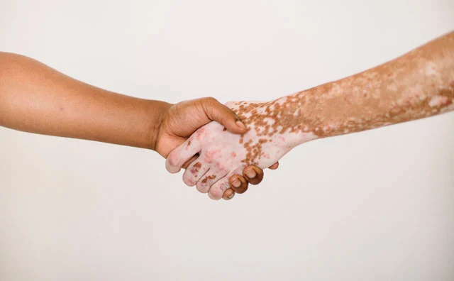 Vitiligo - Recomendaciones para su tratamiento