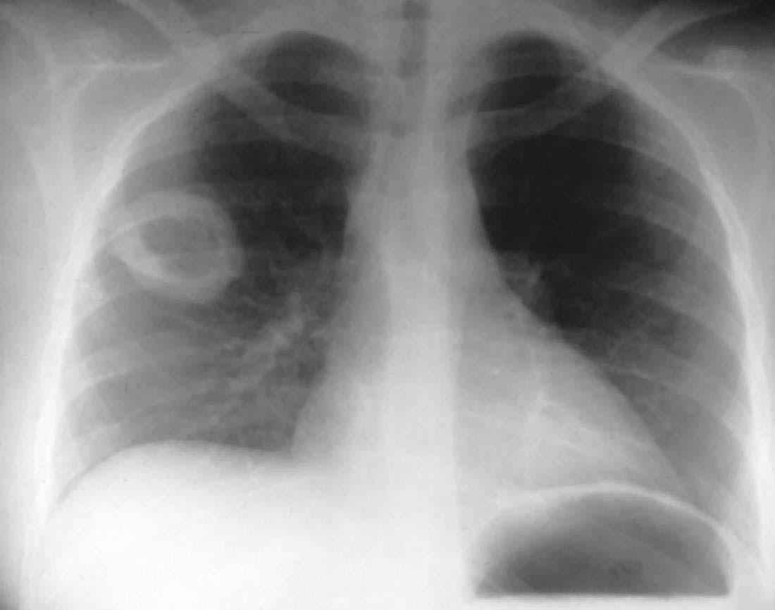Туберкулез легкого рентгенограмма. Каверна туберкулез рентген. Туберкулезная каверна рентген. Кавернозный туберкулез рентген. Туберкулезные каверны на рентгене.