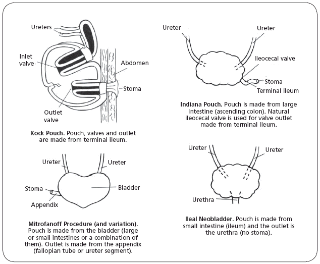 Seeking Healthy Life What is a Urostomy Surgery? Types of Urostomy