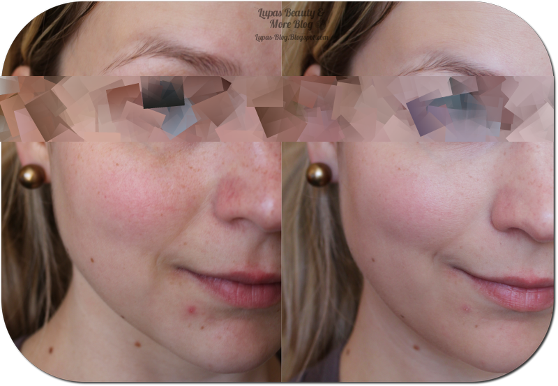 nealkhoerr Rote Pickel Im Gesicht Abdecken