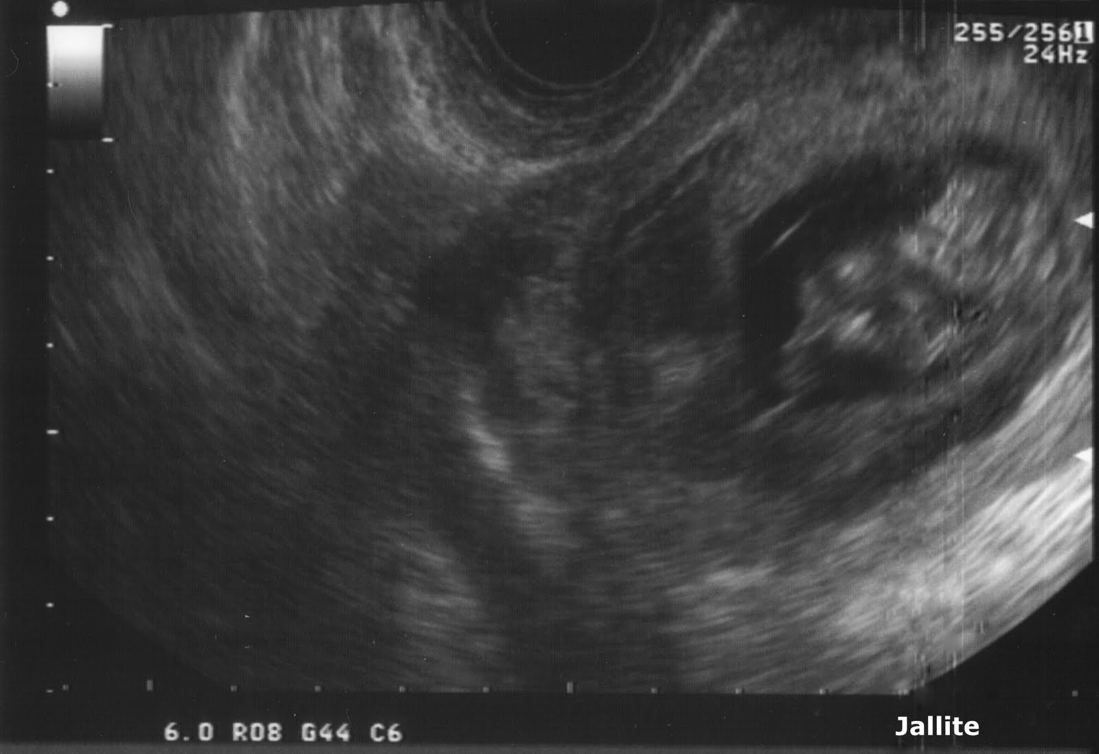 cuanto tiempo tarda en desaparecer un hematoma intrauterino cuanto tiempo tarda en desaparecer un hematoma intrauterino