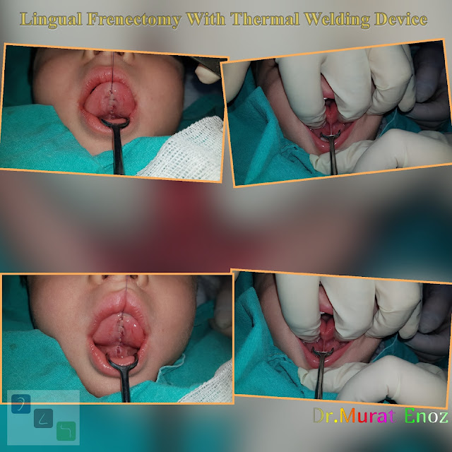 Lingual Frenectomy With Thermal Welding Device