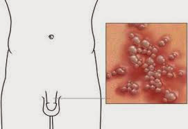 Herpes-Genital-cosas-importantes-que-debe-saber