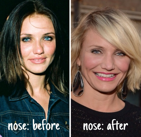Cameron Diaz Plastic Surgery Before and After | Kim Zolciak Plastic Surgery