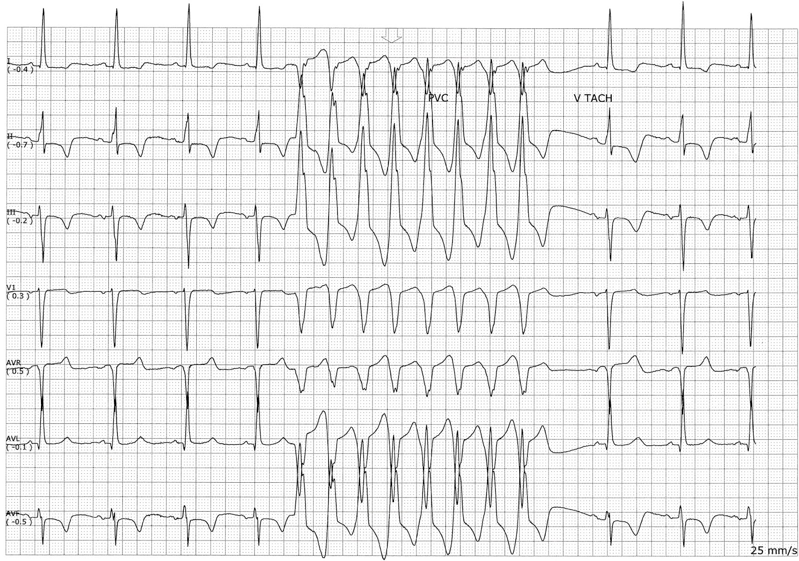 Nurse Health Guides Sinus bradycardia with a run of nonsustained VT