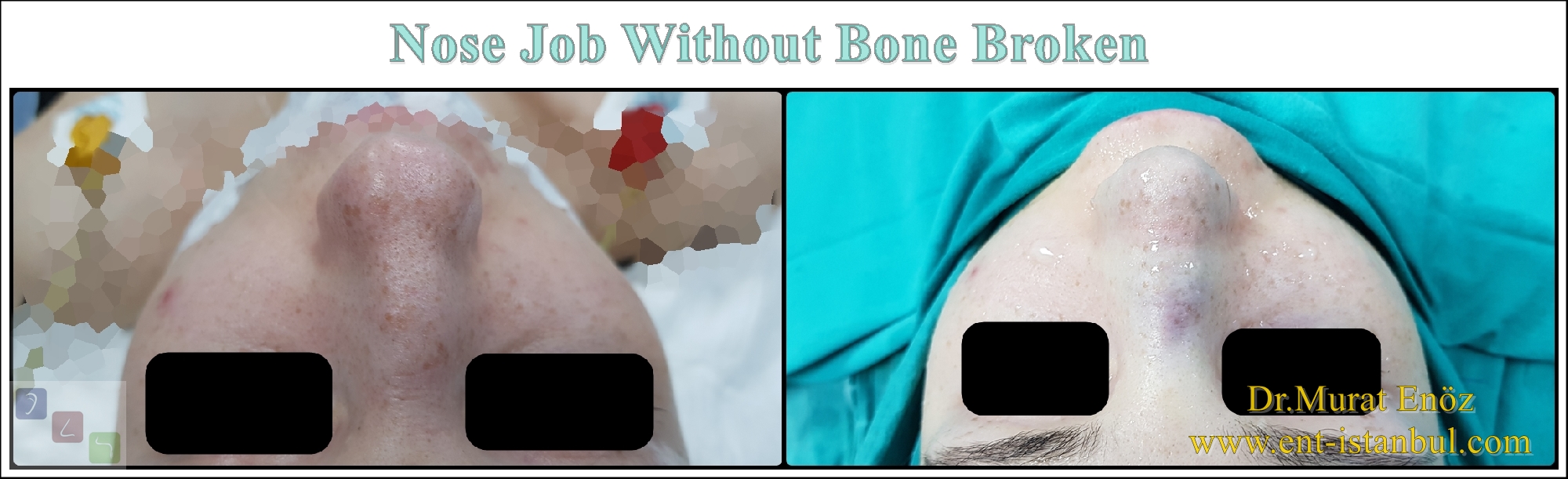 We Performed Again Nose Job Without Breaking The Bone
