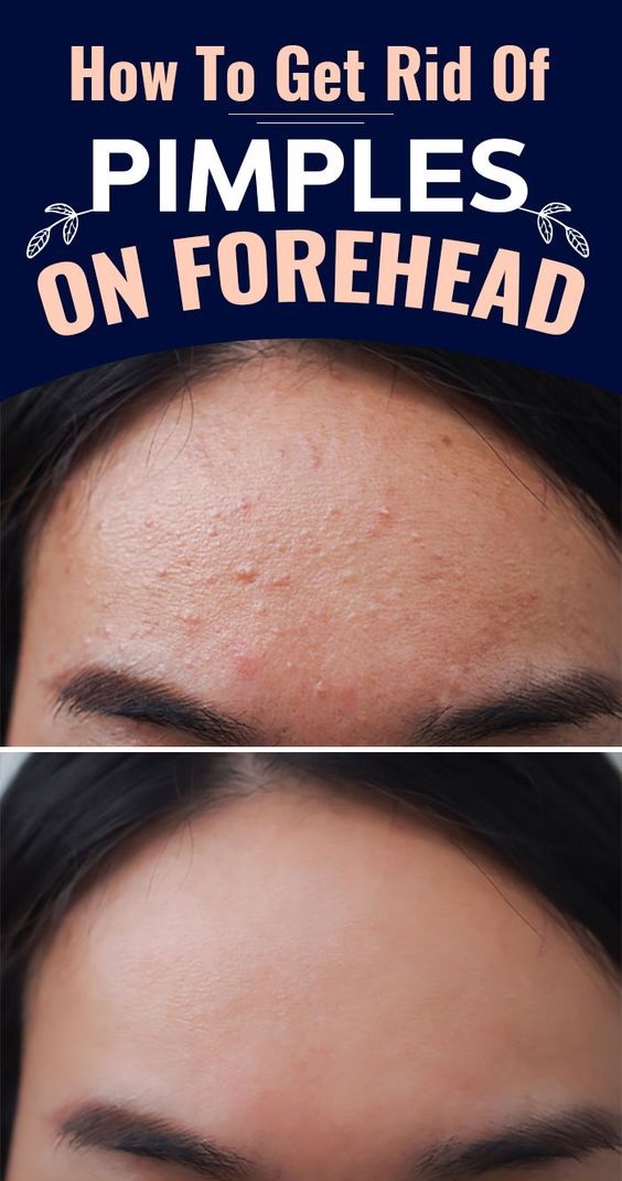 Forehead Acne Causes Treatment And Prevention Tips Wellness Days