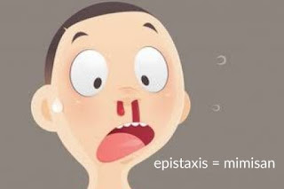 Kode ICD 10 Epistaksis, gejala perdarahan di hidung (mimisan)