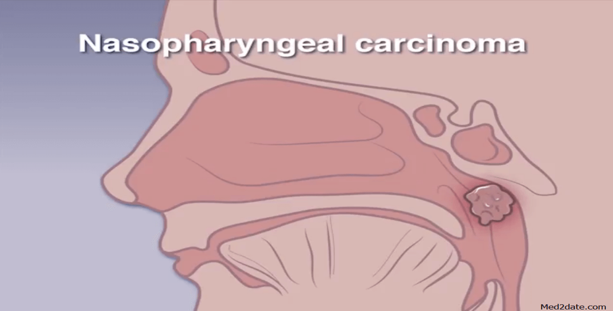 Nasopharyngeal Cancer Symptoms Stages Treatment Survival Faqs