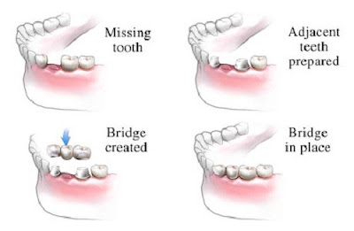 Cầu răng sứ có ưu điểm gì nổi trội?