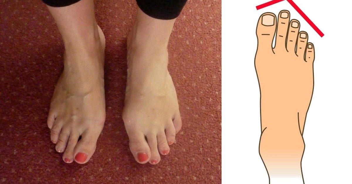 Makna Jari Telunjuk Kaki Lebih Panjang Dari Jempol Kaki