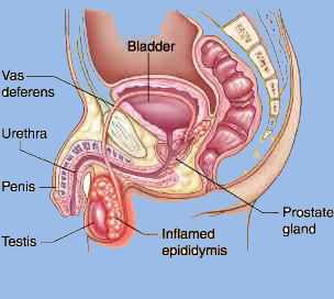 Epididimita din prostatită