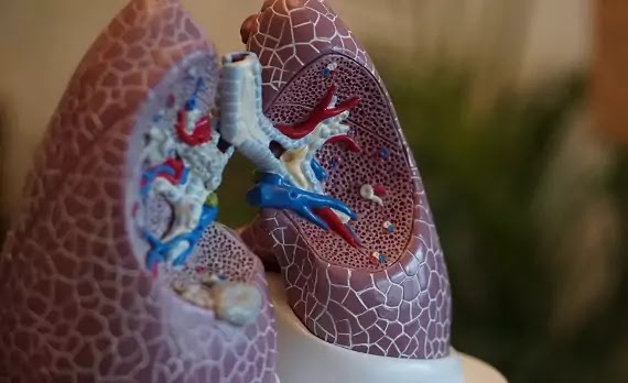 Asbestos- A Major Cause of Lung Cancer