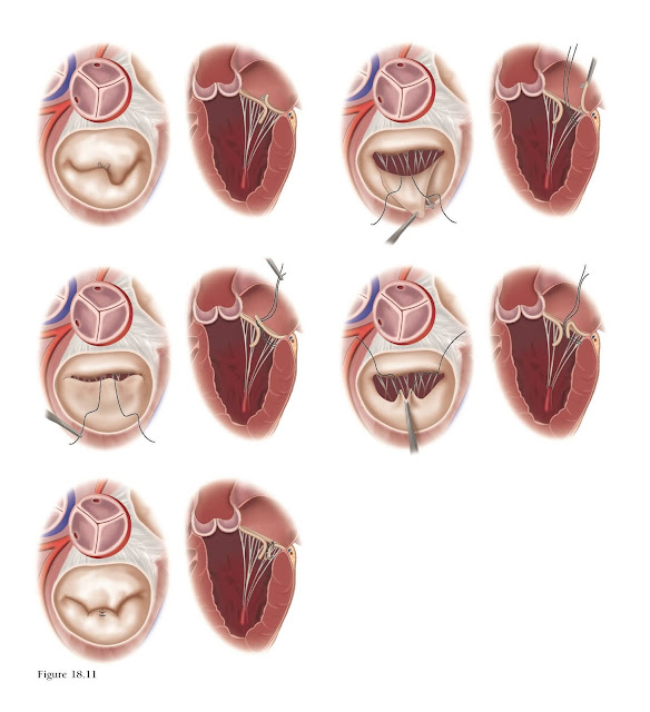Posterior ventricular anchoring neochordoplasty (PVAN) technique.
