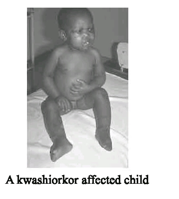 A Kwashior Affected Child