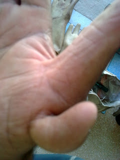 useless thumb