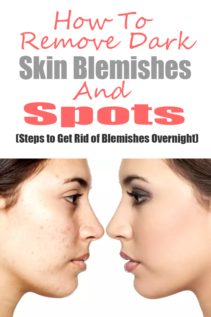 How To Remove Dark Skin Blemishes And Spots