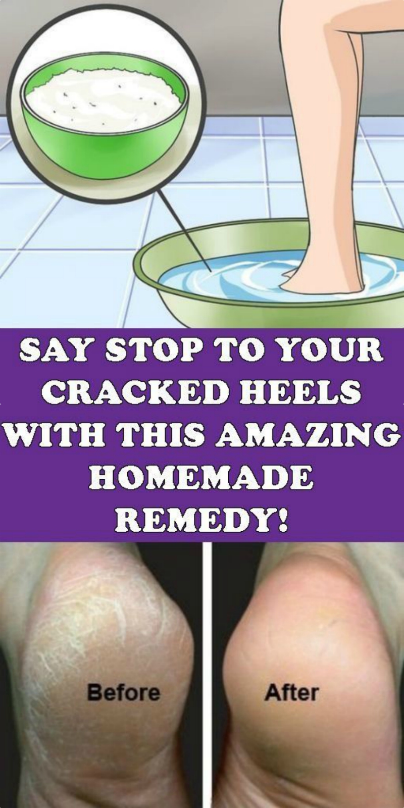 SAY STOP TO YOUR CRACKED HEELS WITH THIS AMAZING HOMEMADE REMEDY