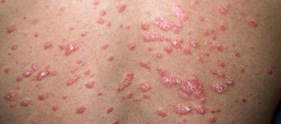 Psoriasis treatment in Trivandrum,Kerala