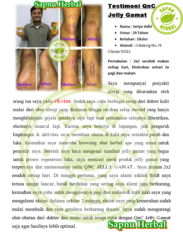 Obat Benjolan Berisi Cairan Pasca Bekas Luka Bakar , TERBUKTI MANJUR!! Obat Benjolan Berisi Cairan Pasca Bekas Luka Bakar , TERBUKTI MANJUR!!