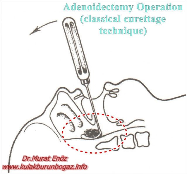 Adenoidectomy Operation