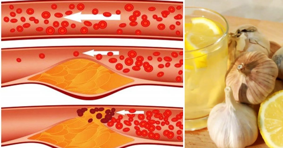 Unclog Your Arteries, Prevent Heart Disease Using This Traditional
