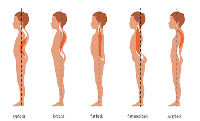 SPINAL CURVE DISORDERS TYPES WITH SYMPTOMS