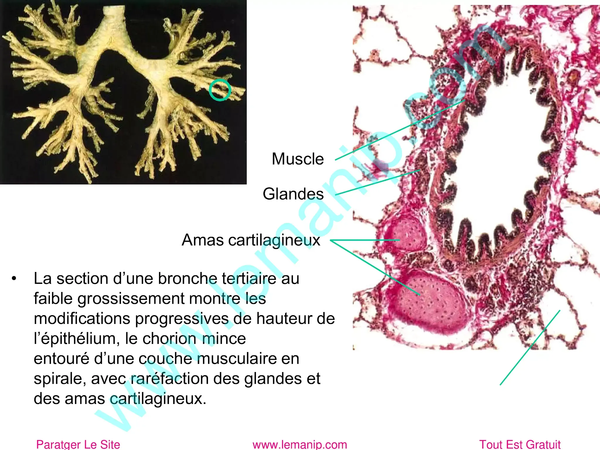 La bronche tertiaire