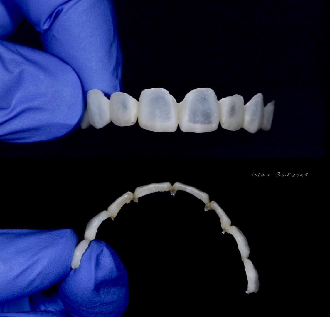 Ceramic veneers preparartion .. Part 3 " Guided prep. " Dental Esthetics