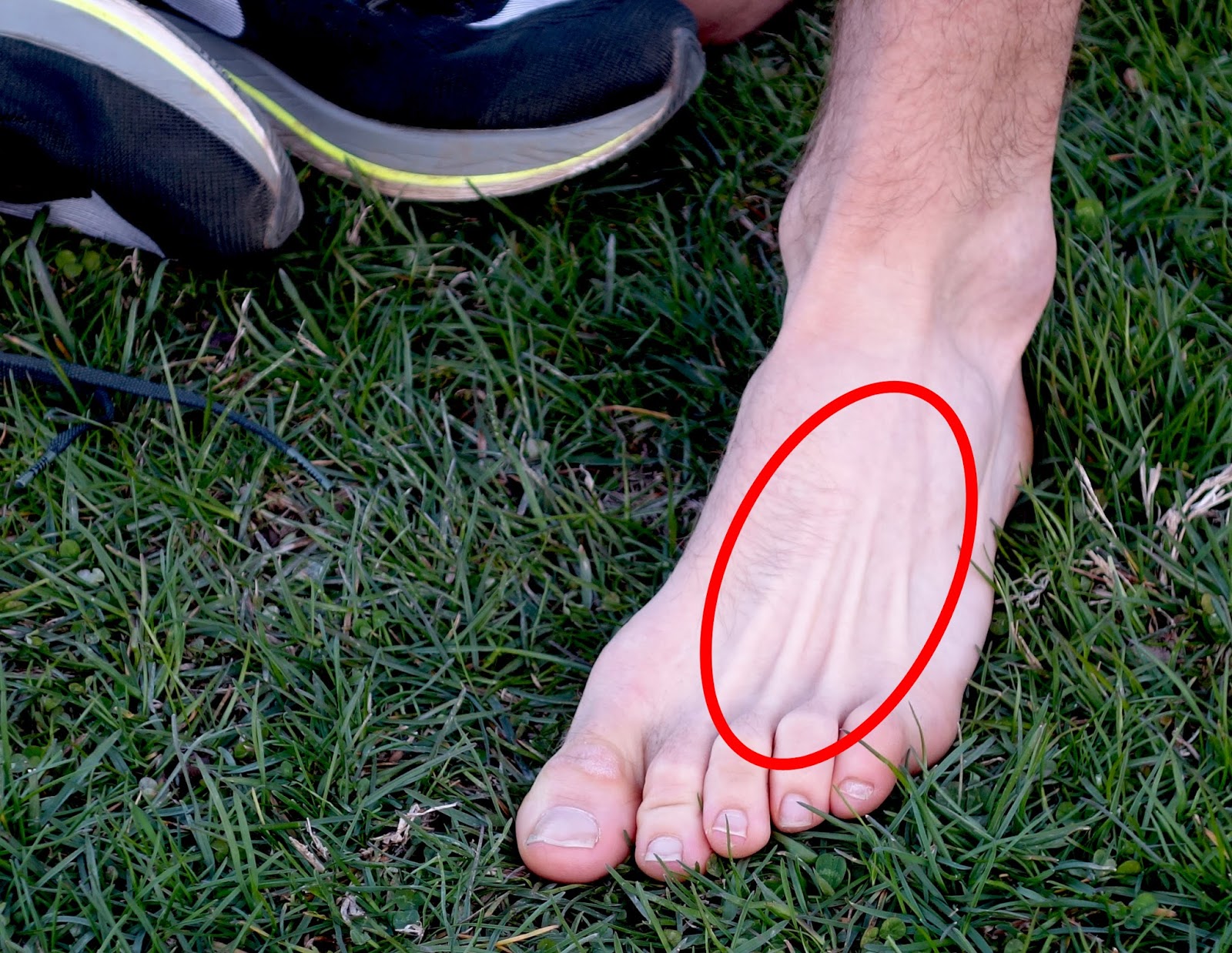 Running Writings What Causes Metatarsal Stress Fracture In Runners