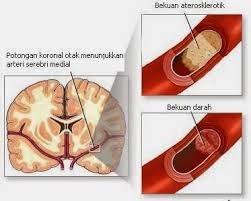 Obat Stroke Iskemik Obat Stroke Iskemik