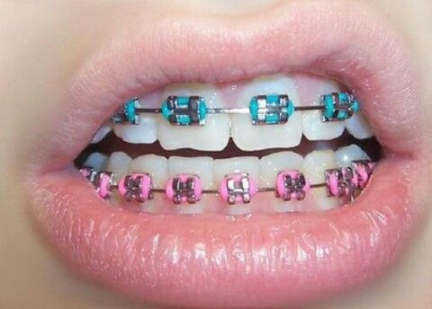Hira Hitsumi Its Time For Braces Part 1