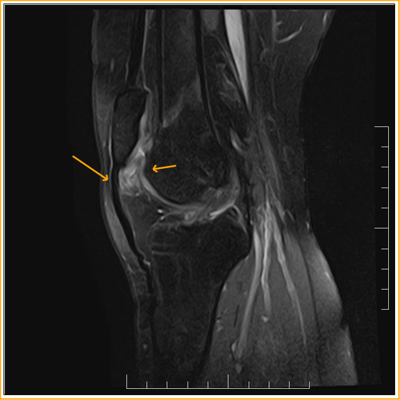 Superolateral Hoffa’s Fat Pad Edema Patellofemoral Impingement Sumer