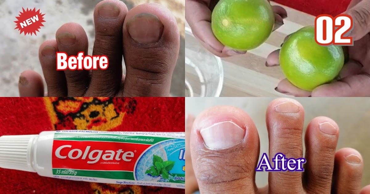 How to clean Toenails at Home without Equipment R. Beauty Tips R