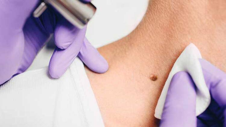 Et Benlerini Yok Edecek 5 Doğal Yöntem