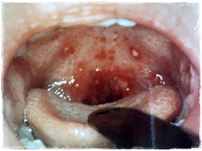 herpangina en nios
