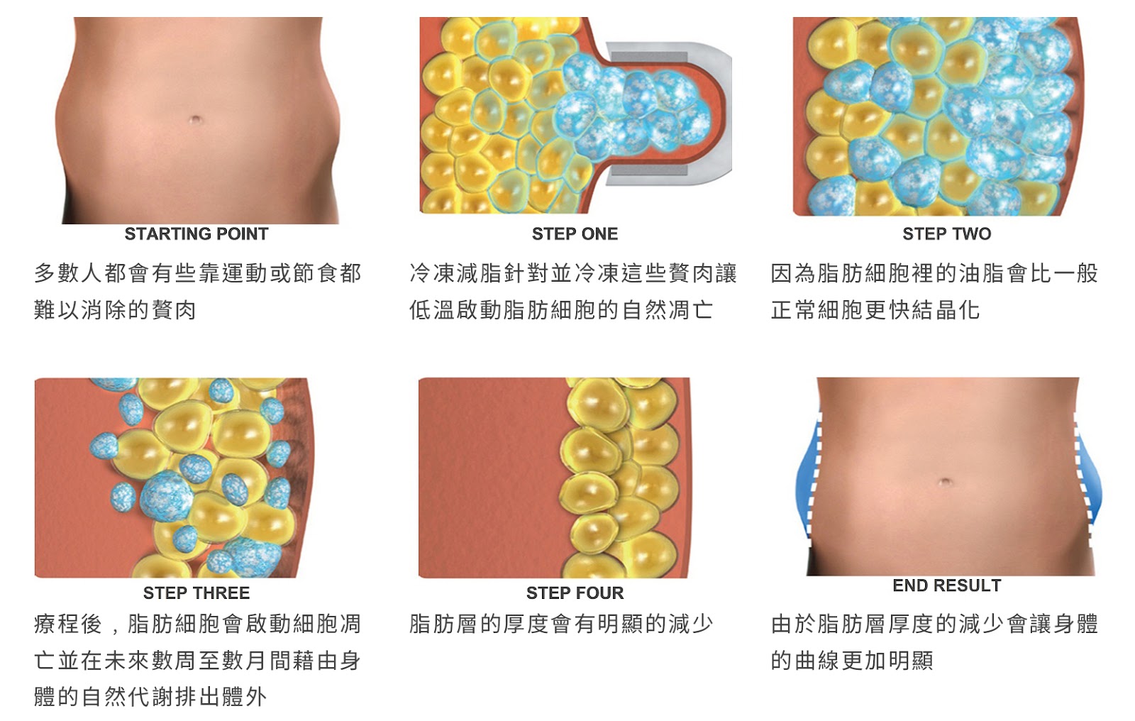 CoolSculpting酷爾塑平冷凍減脂冷凍溶脂價錢冷凍減脂心得冷凍溶脂手臂冷凍溶脂推薦新竹酷塑價格效果新竹體雕推薦非侵入式體雕04
