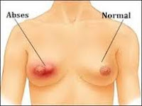 Gambar Kanker Payudara Asli